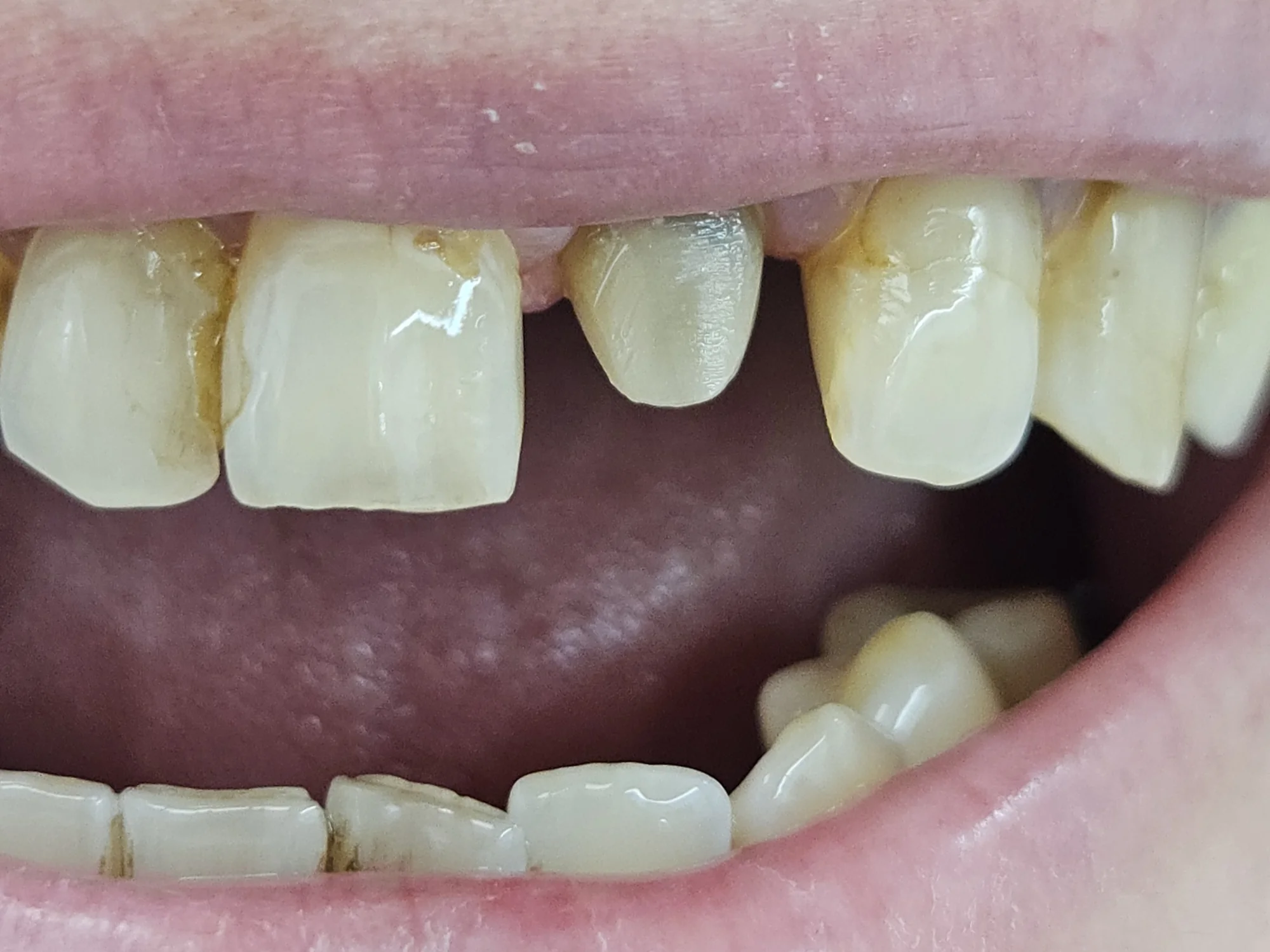 Před: Vrstvená VM9 — celkový pohled