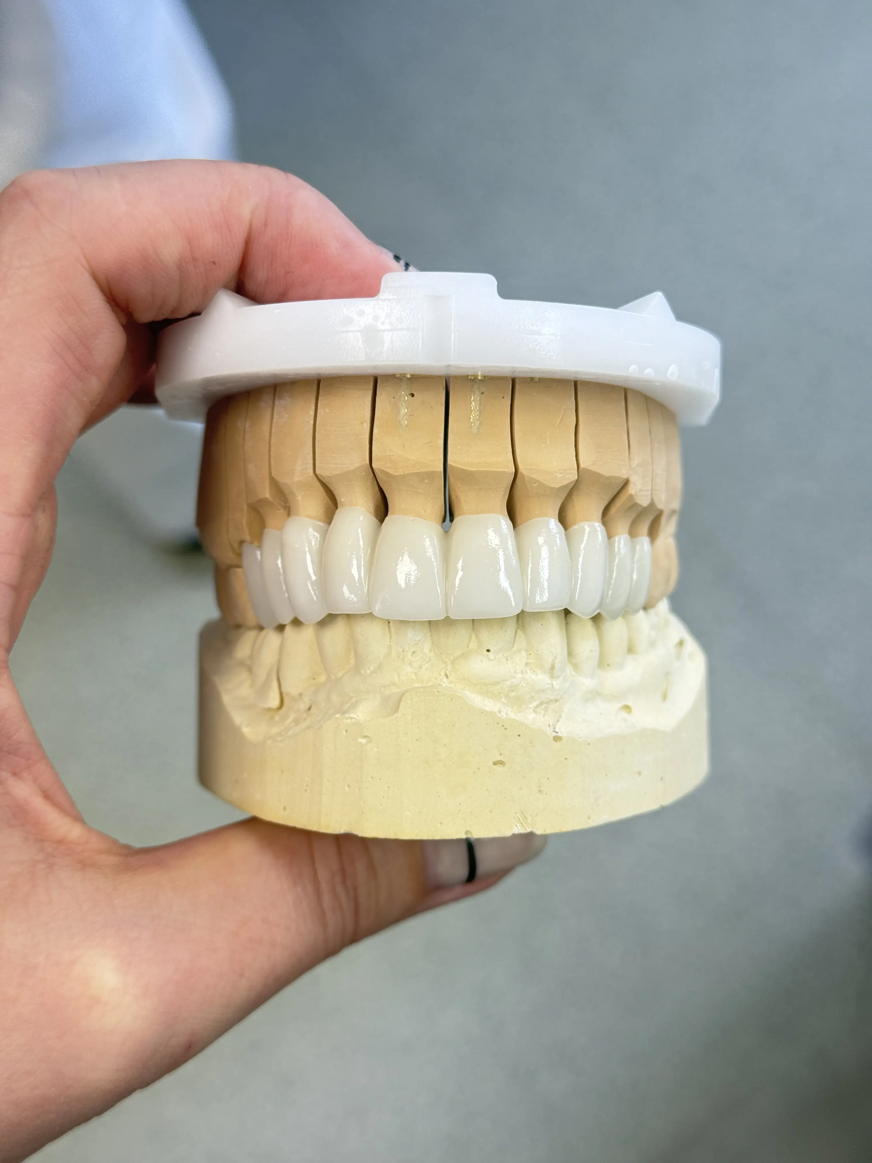Anatomické zirkonové korunky — barva B1