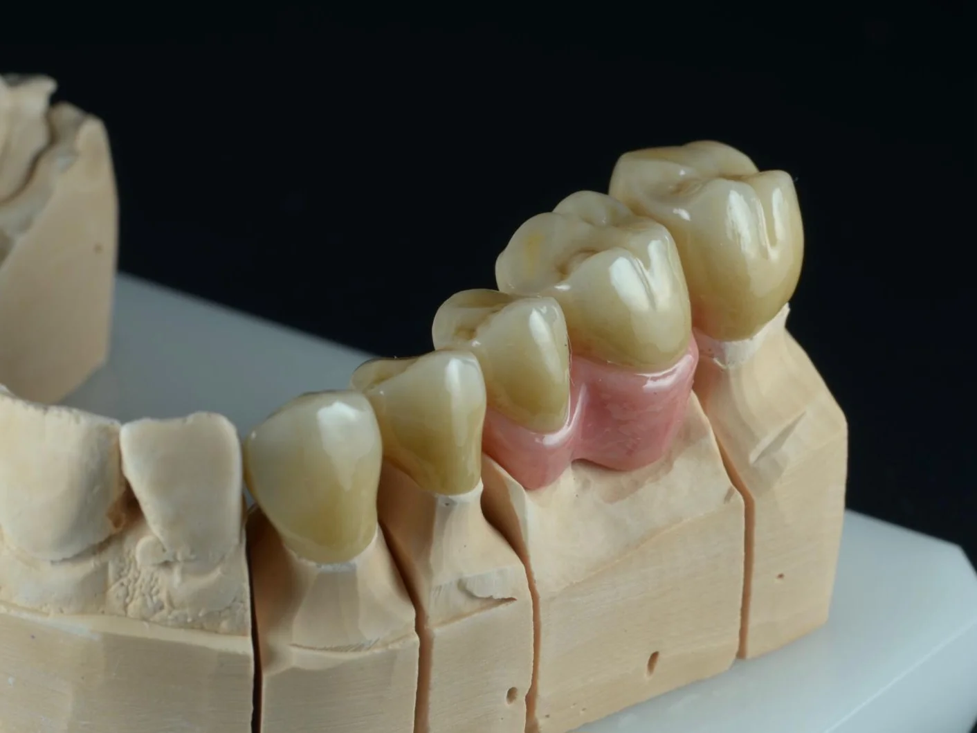 Dopalovaná gingiva II.
