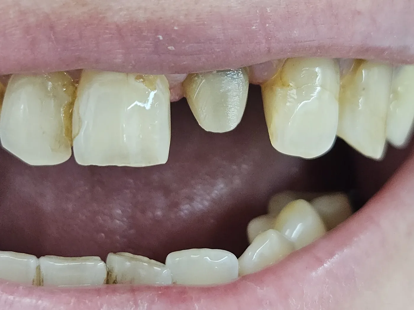 Před: Vrstvená VM9 — celkový pohled