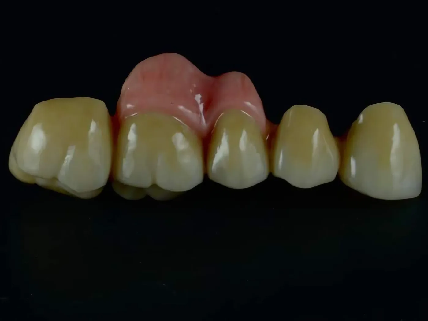 Dopalovaná gingiva I.